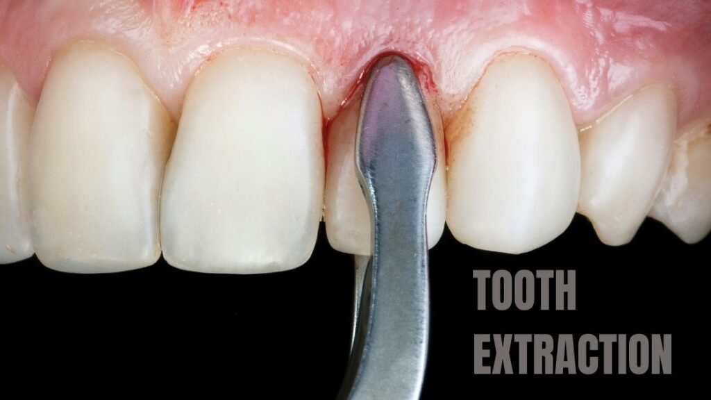 Understanding Tooth Extraction Everything You Need to Know