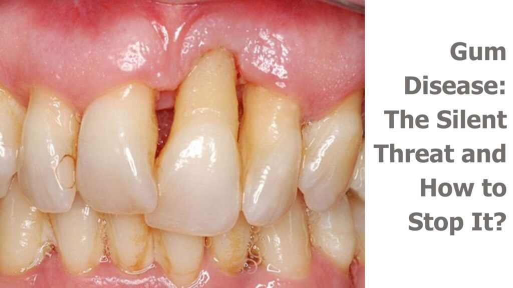 Select Gum Disease: The Silent Threat and How to Stop It? Gum Disease: The Silent Threat and How to Stop It?