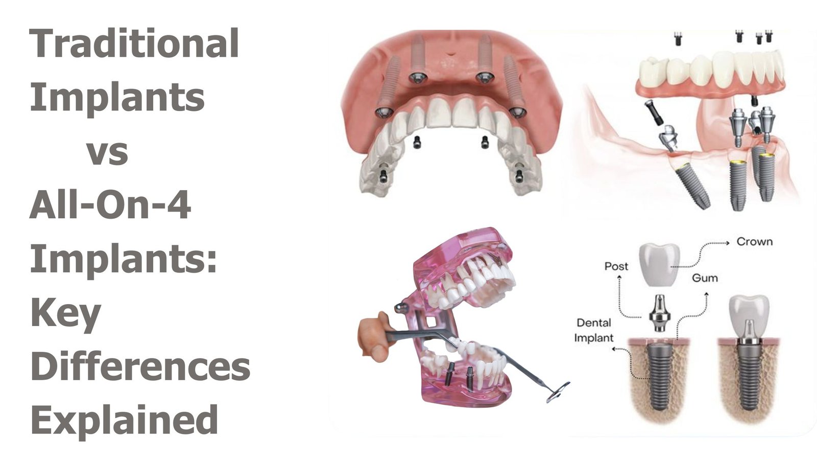 Traditional Implants vs. All-On-4 Implants: Key Differences Explained